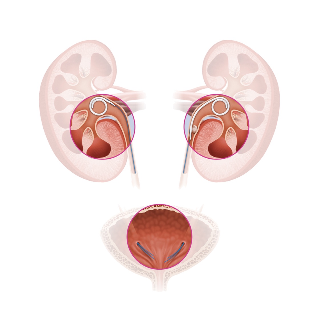 Stents JFill